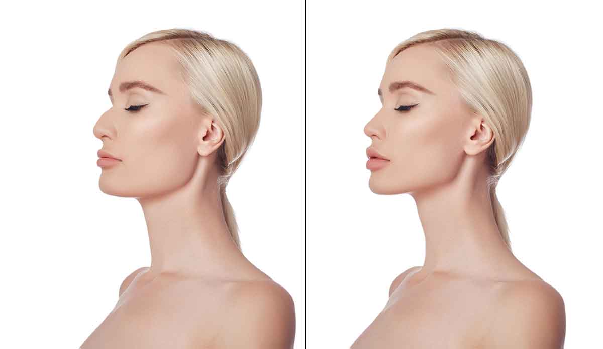 Rhinoplasty Recovery Timeline: From Beginning To End